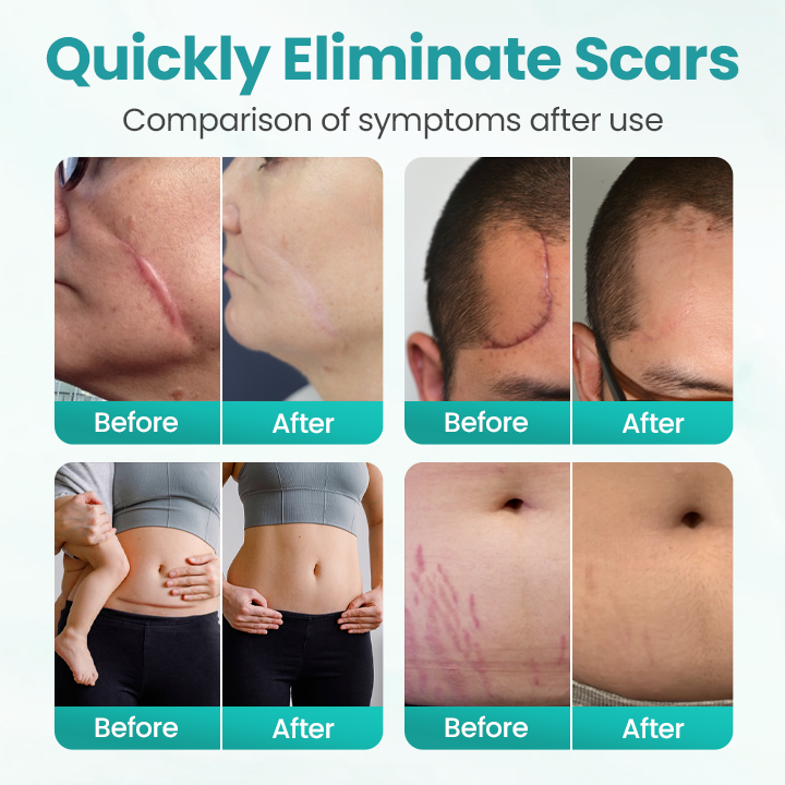 BBOJI® EliteAloe ScarSolve Spray