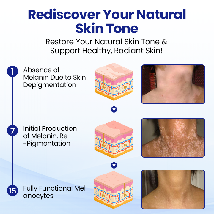 Lovilds® Vitiligo Treatment Spray