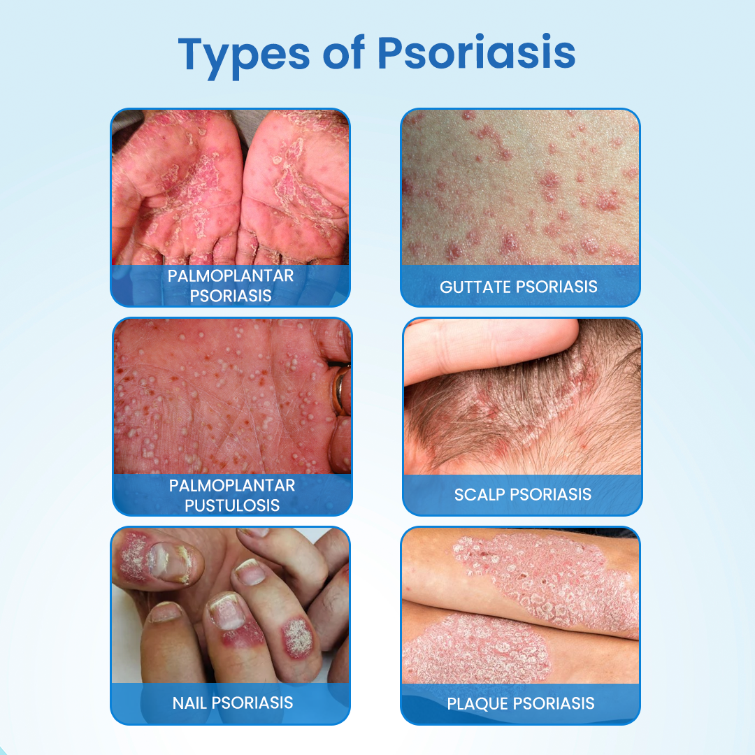 BBOJI® MagnesiumHerb Psoriasis Relief Cream