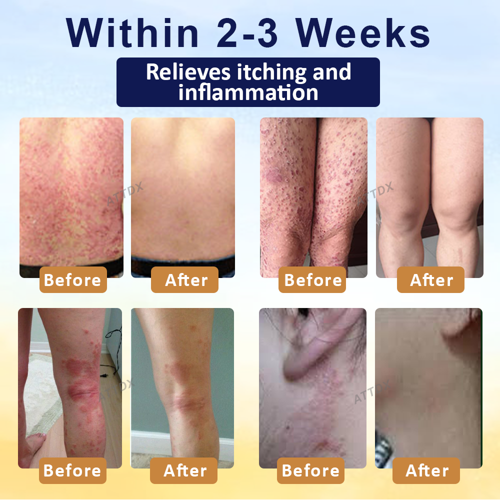 LOVILDS® PsoriasisCare Mellifera Venom Skin Healing Spray🔥