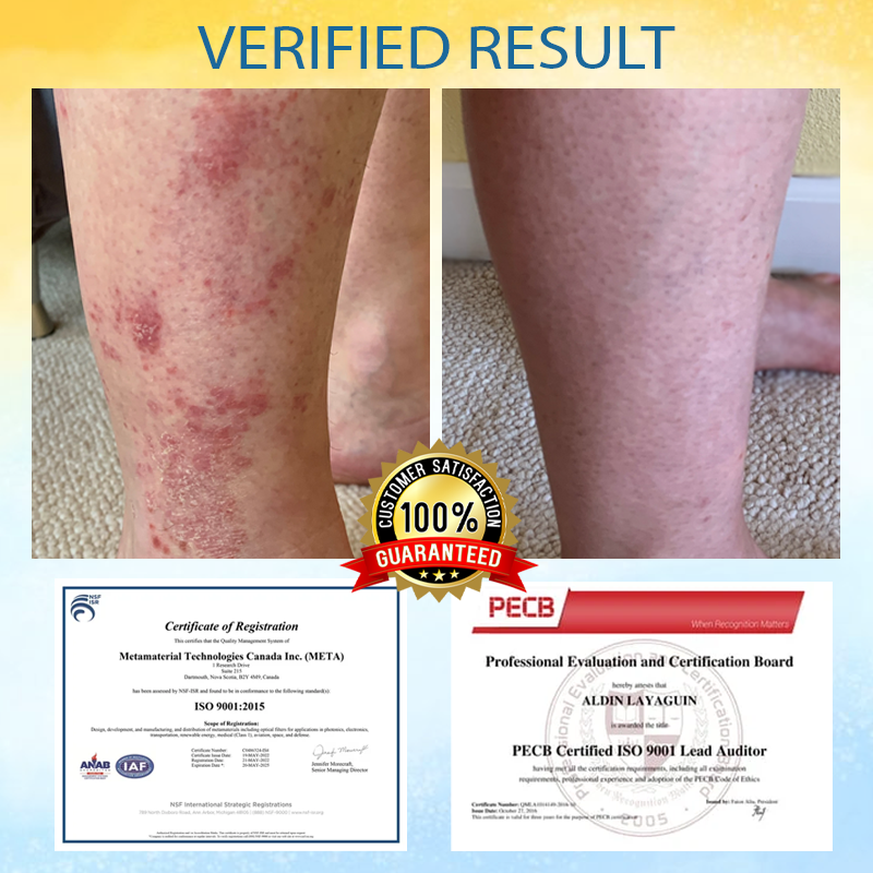 LOVILDS® PsoriasisCare Mellifera Venom Skin Healing Spray🔥