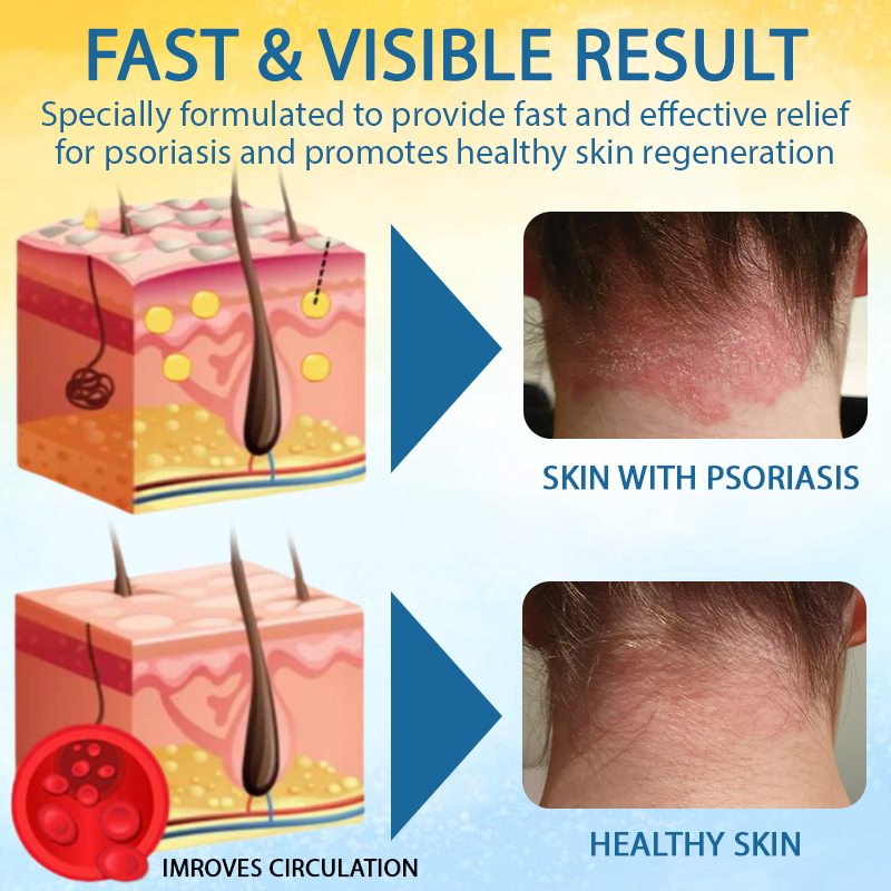 LOVILDS® PsoriasisCare Mellifera Venom Skin Healing Spray🔥