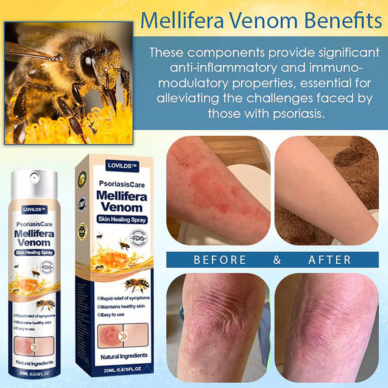 LOVILDS® PsoriasisCare Mellifera Venom Skin Healing Spray🔥