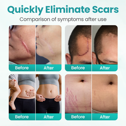 BBOJI® EliteAloe ScarSolve Spray