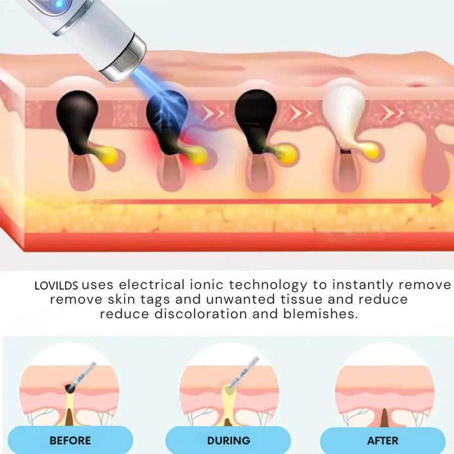 🔥LOVILDS™ Non-Invasive Mole and Wart Removal Laser Pen