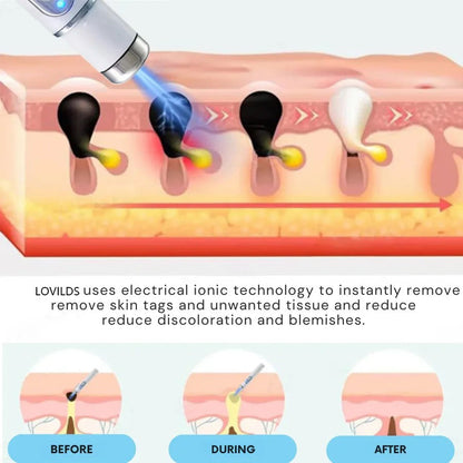 🔥LOVILDS™ Non-Invasive Mole and Wart Removal Laser Pen
