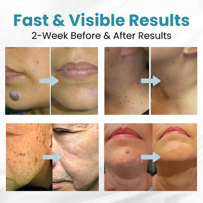 🔥LOVILDS™ Non-Invasive Mole and Wart Removal Laser Pen