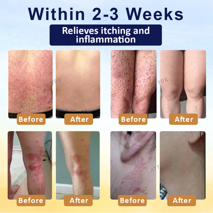 LOVILDS® PsoriasisCare Mellifera Venom Skin Healing Spray🔥