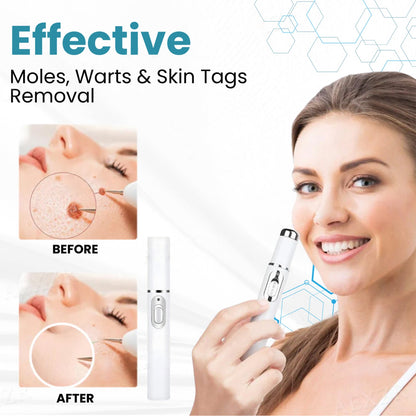 🔥LOVILDS™ Non-Invasive Mole and Wart Removal Laser Pen